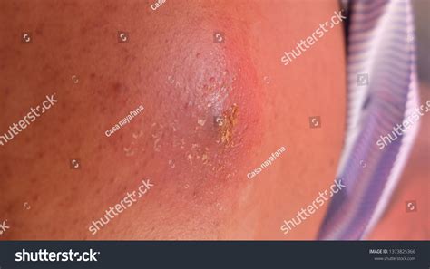 Infected Sebaceous Cyst Abscess Formation 스톡 사진 1373825366 Shutterstock