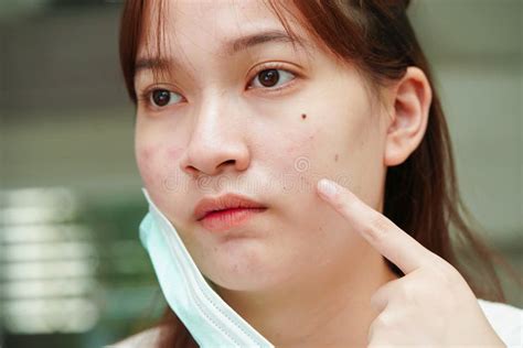 Acne Pimple And Scar On Skin Face Disorders Of Sebaceous Glands