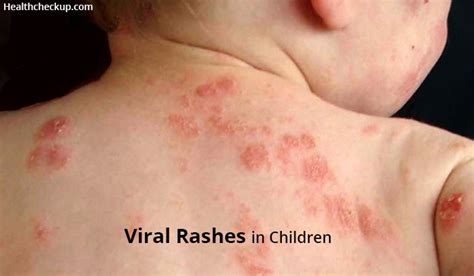 Few Unknown And Uncommon Rashes Appeared On Your Kids Skin Like As