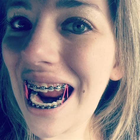 Braces Girlswithbraces Metalbraces Elastics Powerchain Dental Braces Teeth Braces