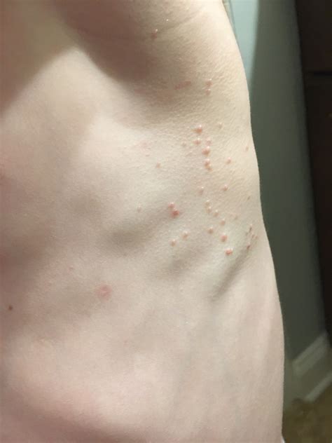 Molluscum Contagiosum Renew Dermatology Birmingham Al Based