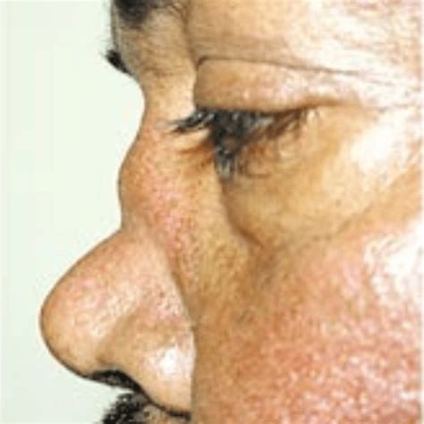 Saddle Nose Deformity Image The Clinical Problem Solvers
