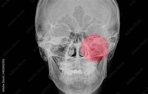 Xray Film Of A Skull Of A Patient Paranasal Sinus With Acute Left Maxillary Sinusitis Photos