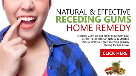 Receding Gums Home Remedy By Jilldominguez Issuu