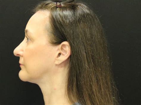 Case 16 Face And Neck Lifts Before And After Gallery