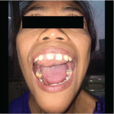 Case 2 A Hard Palate Mass B Swelling In The Bilateral Maxilla And