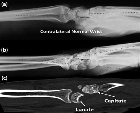 A Normal Lateral Wrist Radiograph Showing The Proper Alignment Of