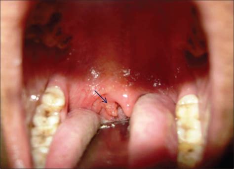 Intraoral Mass In Right Tonsillar And Lateral Pharyngeal Wall Arrow