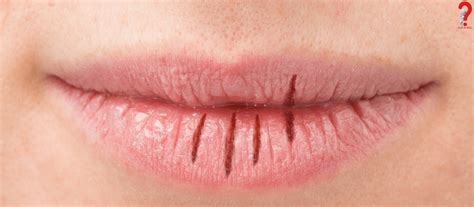 How To Reduce Swelling In Lip Causes Treatment Howtowiki