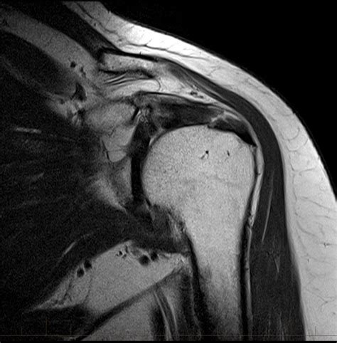 Here we look at the common causes, symptoms, diagnosis and treatment typically, supraspinatus tendonitis is an overuse injury caused by repetitive friction on the tendon, but it can be caused by a shoulder injury. mri-shoulder-supraspinatus-tendon-tear-8 - MRI at ...