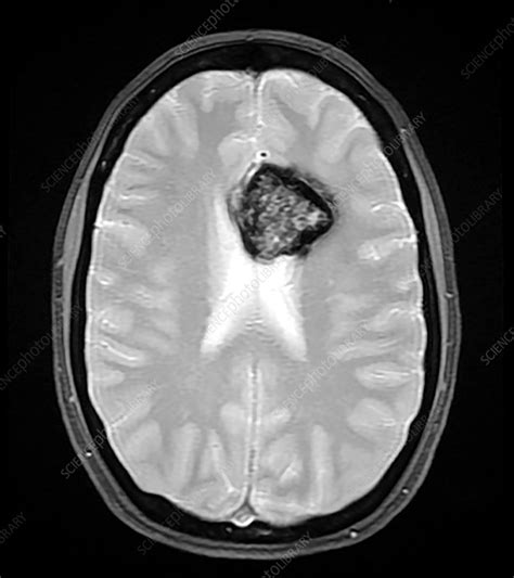 Cavernous Malformation Of Brain Mri Stock Image C0365055
