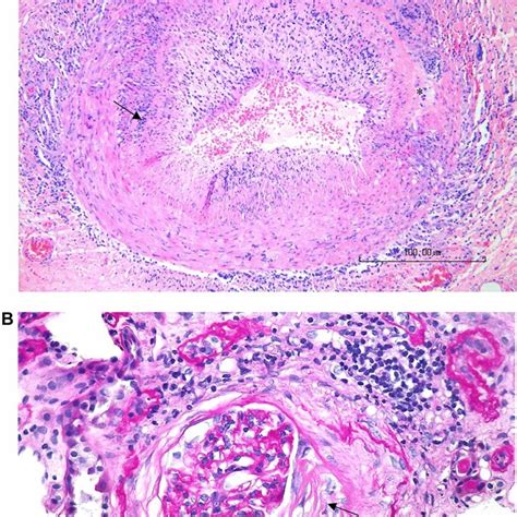 Survival Curves Of Patients With Microscopic Polyangiitis Mpa Based