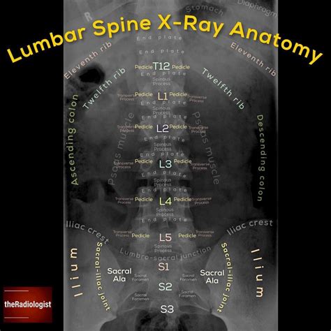 Read On To Learn A System To Review An Ap Lumbar Spine X Ray