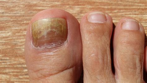Whats The Difference Between Nail Eczema And Nail Psoriasis