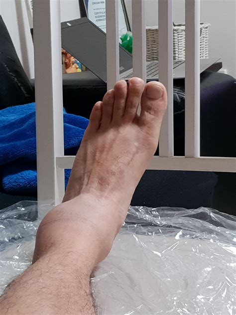 Basketball Ankle Injury Last Year After Stepping On Someone Elses