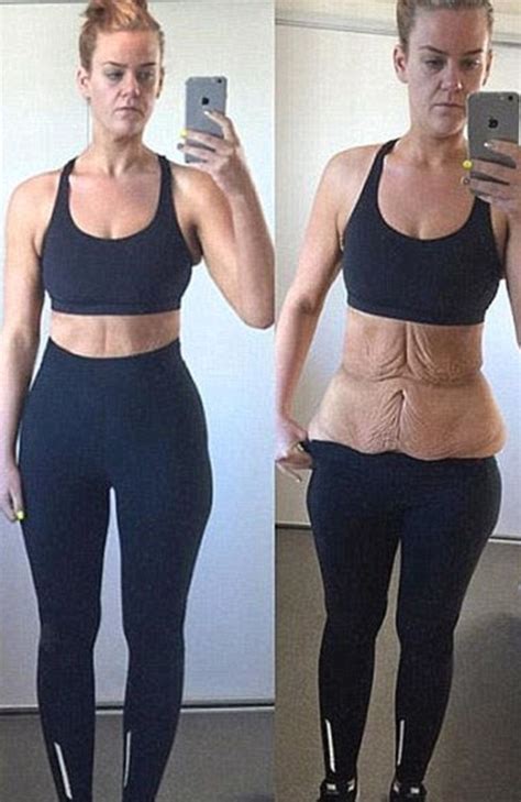 simone anderson weight loss woman shares photo of amazing body after excess skin removal