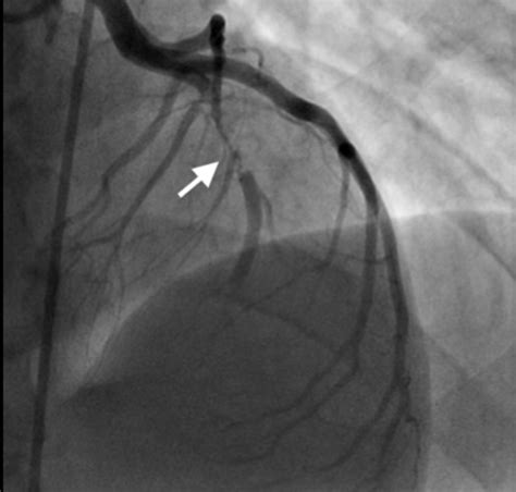 cardiac catheterization cardiac catheterization unive