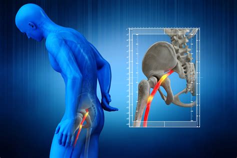 Methods For Sciatic Nerve Pain Relief