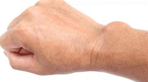 Theres A Cyst On My Wrist Orthopaedic Associates Inc Orthopaedics