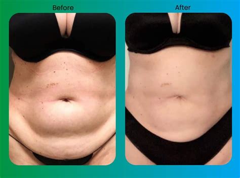 Vaser Liposuction Before And After Results And Pictures