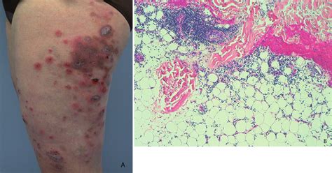 A Clinical Picture Of The Dermatitis B Histological Biopsy