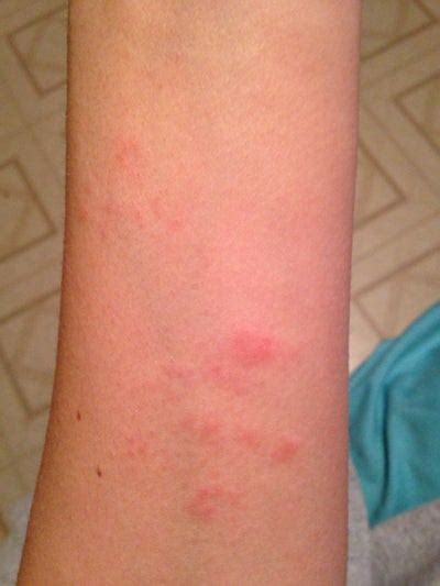 I Have Been Experiencing Random Rash Like Spots On My Forearms Legs
