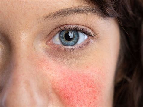 What Not To Eat When You Have Rosacea Rosacea Discoid Lupus