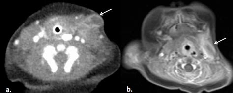 Thirdfourth Branchial Cleft Cyst Neonate With Left Fluctuant Neck