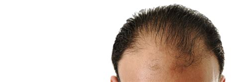 Chaque follicule passe par plusieurs phases : Perte Cheveux Localisée Femme : Perte De Cheveux Normale ...