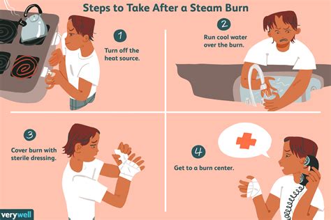 Steam Burns Symptoms Treatment And Prevention