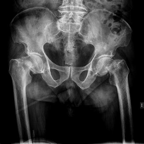 Anteroposterior Radiograph Of The Pelvis Showing Bilateral Femoral Neck