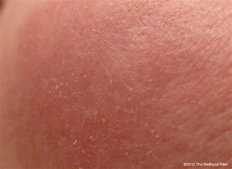 Gluten Rash On Face