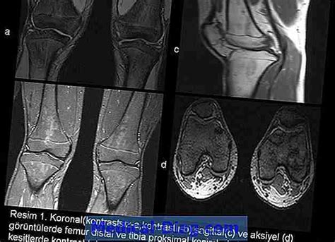 Osteomyelit Symtom Orsaker Och Behandling Medical Diag Com