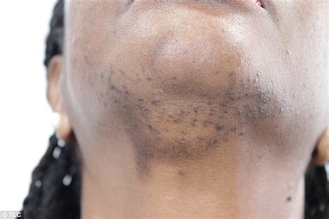 Woman Scarred After Having Laser Treatment To Remove Hairs On Chin