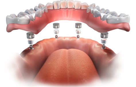 Overdentures Implant Supported Dentures In Schaumburg Il Schaumburg Tooth Doctor