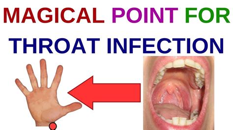 Acupressure Points For Sore Throatthroat Painthroat Infection