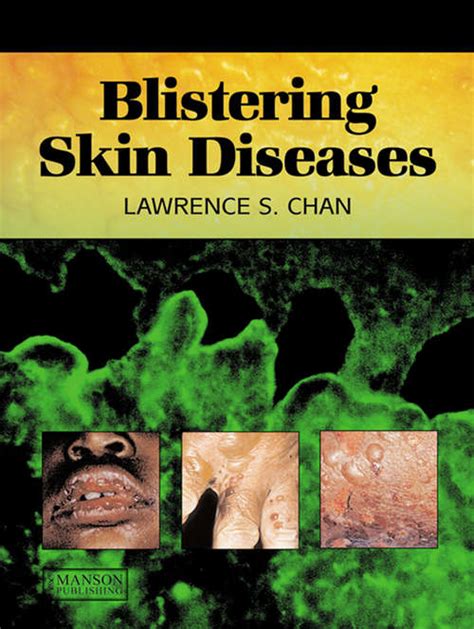 Blistering Skin Diseases Uk Education Collection