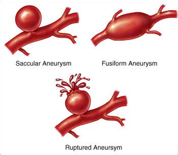 An aneurysm occurs when part of an artery wall weakens, allowing it to balloon out or widen abnormally. Brain Aneurysms | Memphis Vascular Doctors