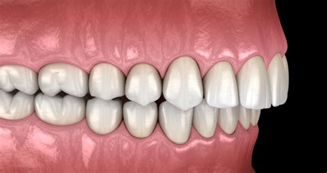 A positive contact will result in a 'tug back' of the shim stock and a negative contact. How to Fix an Overbite with Braces (How Long Does it Take?)
