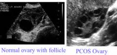 This study reviewed current data on the significance of family history and how prophylactic oophorectomy should. gyn final - endometrial and ovarian cancer flashcards ...