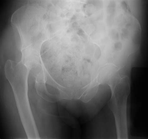 Acetabular Fractures Bone And Joint