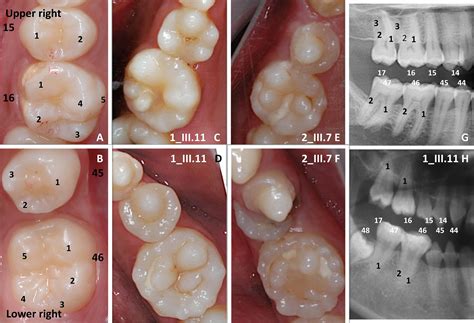 Teeth Genetic Diseases