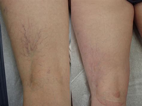 Get an overview of sotradecol (tetradecyl hydrogen sulfate (ester) injection, solution), including its generic name, formulation (i.e. Sclerotherapy | Washington, DC | Center for Laser Surgery
