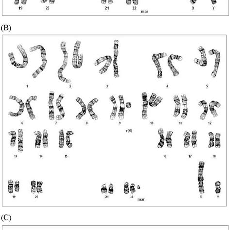 A A Karyotype Of 47xyþmar Mar ¼ Marker Chromosome B A Karyotype