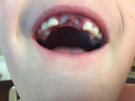 Seven Year Old S Teeth Coming In Crooked Lakewood Orthodontics Blog