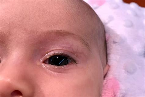 Identification And Treatment Of Pink Eye In Babies The Eye News