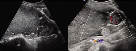 A Large Subchorionic Hematoma In Pregnancy A Case Report Medicine