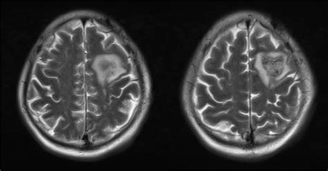 Head Mri Shows Abnormal Signals In The Left Frontal Lobe Combined With