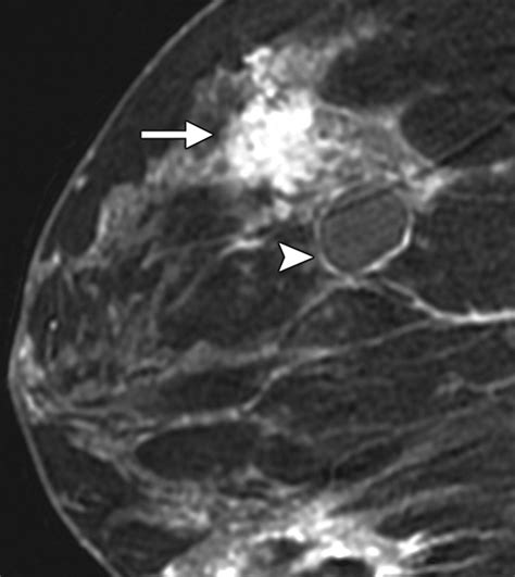 Ductal Carcinoma In Situ Of The Breast Mr Imaging Findings With Histopathologic Correlation