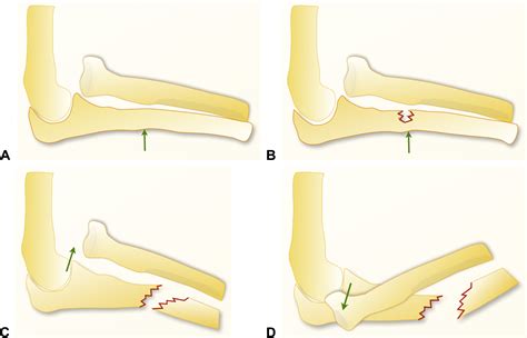 Monteggia Fracture Dislocations A Historical Review Journal Of Hand
